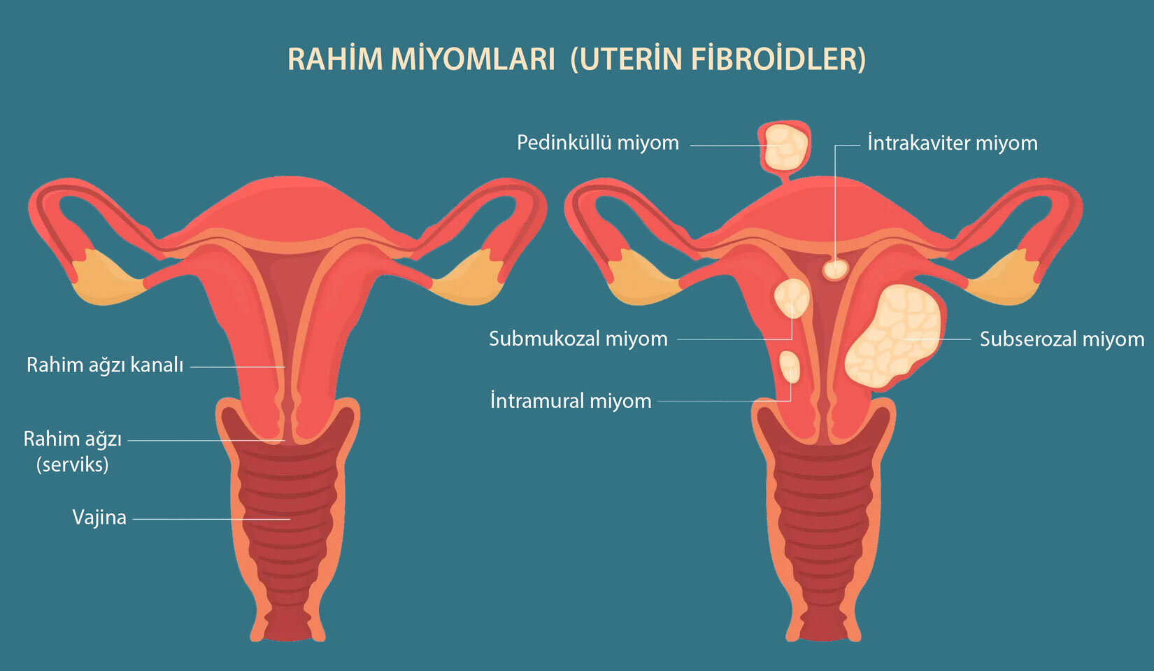 rahimde-miyom-nedir-uterin-fibroid-gorseli-491535.jpg rahimde-miyom-nedir-uterin-fibroid-gorseli-491535.jpg